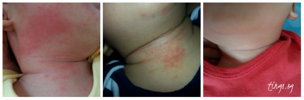 QT's rash progression (L-R: first discovery, before using the soothing cream, after using the soothing cream)